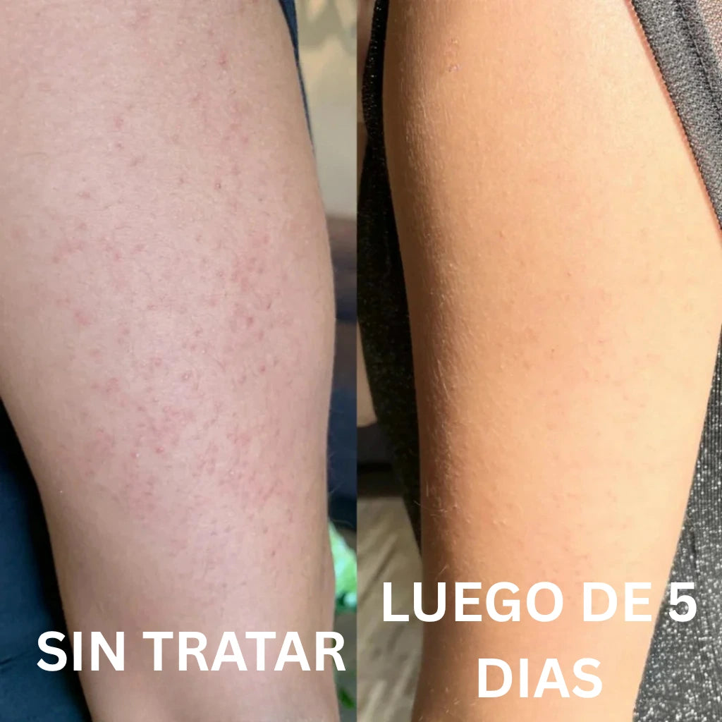 Aceite de Orégano - Lo que tu dermatólogo no te explicó (y probablemente no te va a decir) sobre por qué tus brotes en la piel siempre vuelven