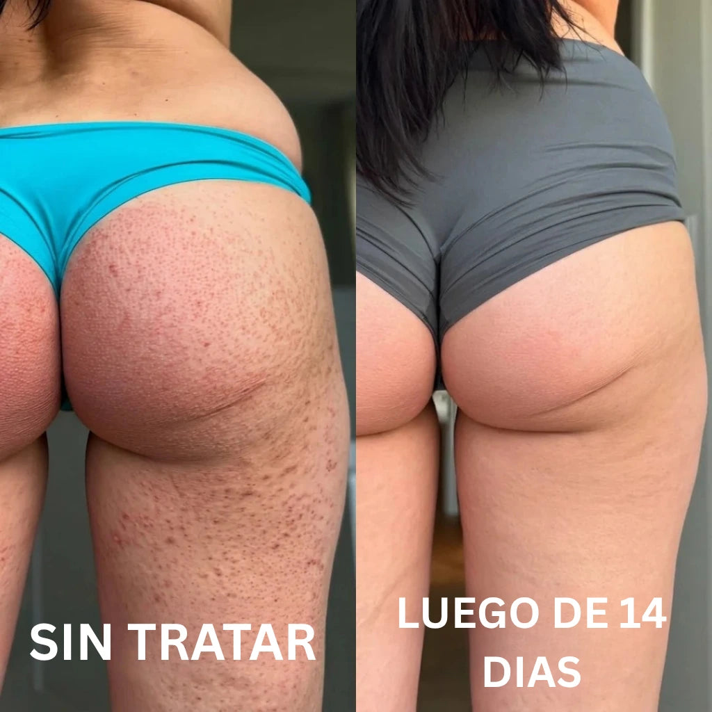 Aceite de Orégano - Lo que tu dermatólogo no te explicó (y probablemente no te va a decir) sobre por qué tus brotes en la piel siempre vuelven