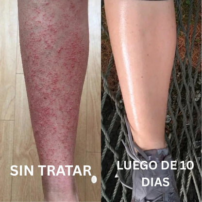 Aceite de Orégano - Lo que tu dermatólogo no te explicó (y probablemente no te va a decir) sobre por qué tus brotes en la piel siempre vuelven